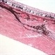 Melanoma involving sclera Melanoma involving sclera